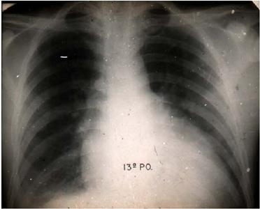 - Radiography of Jo&atilde;o &ldquo;boiadeiro&rdquo; at the 13th
                            postoperative day.