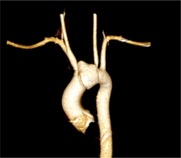 Preoperative CT scan (VRT reconstruction).