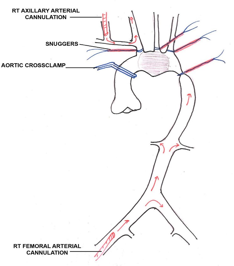 Cannulation strategy.