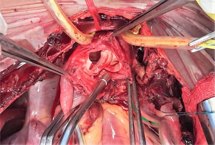 Intraoperative picture showing dissection flap between right
brachiocephalic and left common carotid arteries.