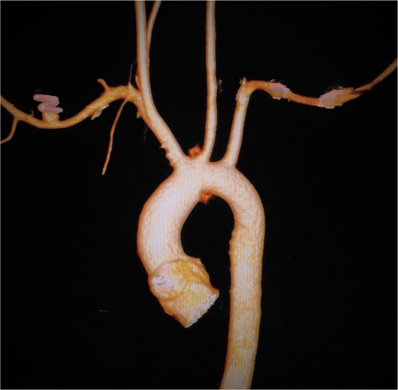 Postoperative CT scan showing almost normal arch with well-flowing
branches.