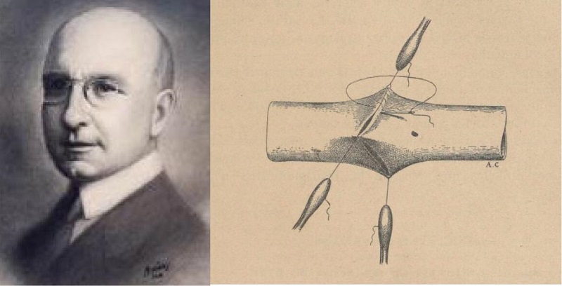 Alex Carrel received the Nobel Prize for creating the vascular suture
                            technique.