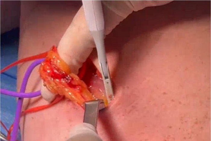 Saphenous vein graft with &ldquo;no-touch&rdquo; technique. Step-by-step
								of a hybrid technique.