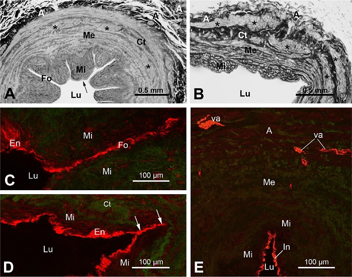 Light microscopy (LM) and laser confocal microscopy (LCM) of
							transverse sections of proximal segment of human great saphenous vein
							(SV) harvested by the no-touch (NT) or conventional (CON) method. A) The
							LM Araldite semithin sections (~ 2 μm) of NT-SV (originally stained with
							toluidine-blue) show a lumen (Lu) and the internal layer of the media
							(Mi) which is covered by the intima (arrow); between Mi are seen inward
							luminal folds (Fo). The external layer of the media (Me) contains
							bundles of smooth muscle (*) and connective tissue (Ct); adventitia (A)
							is at the abluminal site of the vein wall. B) The LM section of
							distended CON-SV shows distended luminal folds. C) The LCM section of
							NT-SV immunolabelled for inducible nitric oxide synthase (iNOS) shows
							iNOS-positive (red) endothelium (En) of Fo giving a false impression of
							a blood vessel being there. D) LCM section of CON-SV shows iNOS-positive
							En in the partially distended luminal fold; a non-distended part of the
							fold might resemble a blood vessel (two arrows). E) LCM section of NT-SV
							shows no connectivity between iNOS-positive vasa vasorum (va) and the
							iNOS-positive luminal intima (In). Note that for C), D), and E), the
							main steps of immunolabelling were carried out on 30 μm frozen
							transverse-sections and involved: (1) fixation with 4% paraformaldehyde;
							(2) incubation with a rabbit polyclonal antibody to iNOS (Santa Cruz
							Biotech); (3) incubation with a goat antirabbit immunoglobulin G Alexa
							Fluor� 568 (Molecular Probes); (4) embedment in Citifluor; and (5)
							examination at a LCM: Leica DMRBE with SPZ confocal head. The images
							were collected at 1.5 μm intervals and then merged as maximal
							projection. It is acknowledged that A) and B) images are modified from
							Ahmed et al.[4],2004; C), D), and E) are from A. Loesch unpublished
							study.