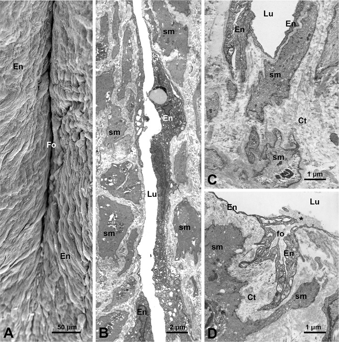 Scanning (SEM) and transmission (TEM) electron microscopy of human
							great saphenous vein harvested by the no-touch (A - C) and conventional
							methods (D). A) SEM image shows the luminal aspect of an inward intimal
							fold (Fo) between two segments of the inner media that is covered by the
							endothelium (En). B) TEM image shows an inside view of a fragment of a
							Fo with its lumen (Lu) and En; on either side of Lu, smooth muscle cells
							(sm) and connective tissue (Ct) of the media are present. C) TEM image
							shows a bottom region of a Fo; note the absence of the vasa vasorum
							vessels in this region. D) TEM Image shows the luminal aspects of
							conventionally harvested vein displaying a small branching fold (fo),
							protruding into the media. Note that the fo lumen is an extension of the
							vein Lu, as also is En. At the opening (~ 0.5 μm) of this fo note a
							clump (asterisk) of the blood components. It is acknowledged that A)
							image is modified from Vasilakis et al.[5], 2004; B), C), and D) are
							from A. Loesch unpublished study.