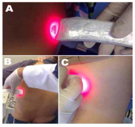 Low intensity laser irradiations. São José dos Campos, São Paulo, 2016.