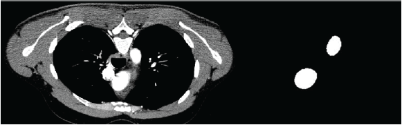 Identificaci&oacute;n de los contornos de la aorta ascendente y descendente a partir del TAC