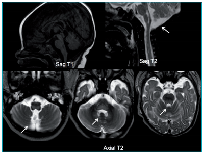 RM: T1 Sagital, T2 Sagital e T2 Axial mostrando les&otilde;es hipointensas (T1) e hiperintensas (T2) bem definidas na por&ccedil;&atilde;o posterior da ponte e do bulbo.