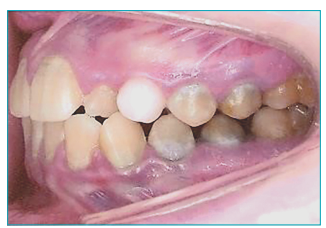 Aspecto intrabucal com reten&ccedil;&atilde;o prolongada do canino dec&iacute;duo superior esquerdo e pigmenta&ccedil;&atilde;o esverdeada dos dentes.
