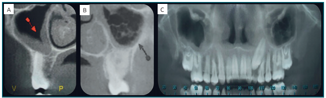 (A) Imagem sagital com presen&ccedil;a de calcifica&ccedil;&atilde;o distr&oacute;fica na periferia do seio maxilar; (B) Imagem sagital com presen&ccedil;a de calcifica&ccedil;&atilde;o distr&oacute;fica na periferia do seio maxilar e in&iacute;cio de &aacute;reas c&aacute;lcicas no centro do seio maxilar; (C) Imagem panor&acirc;mica com presen&ccedil;a de calcifica&ccedil;&otilde;es distr&oacute;ficas no seio maxilar.