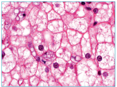 Esteatose microvesicular intense com deposi&ccedil;&atilde;o focal de cristais de colesterol na c&eacute;lula Kupffer no microsc&oacute;pio &oacute;tico.