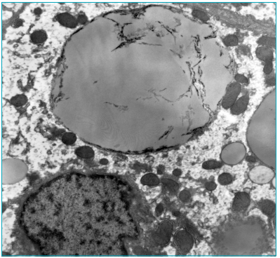 Dep&oacute;sitos de triglic&eacute;rides &agrave;s vezes se fragmentavam com estrias irregulares (aspect da &ldquo;ma&ccedil;&atilde; mordida&rdquo;). 