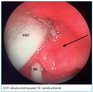 Imagem da broncoscopia evidenciando o edema de mucosa (seta) envolvendo a cânula orotraqueal e a sonda enteral.