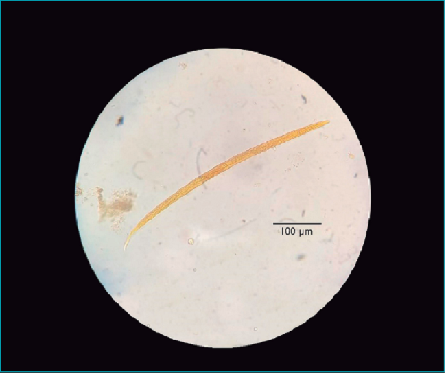 Larva rabditoide, em muda, de Strongyloides stercoralis isolada na segunda amostra de fezes coletada da criança.