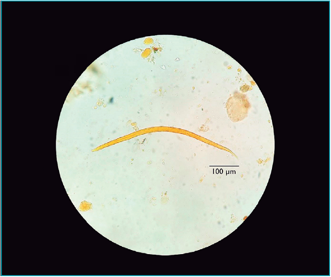 Larva filarioide de Strongyloides stercoralis isolada na segunda amostra de fezes coletada do pai da criança.