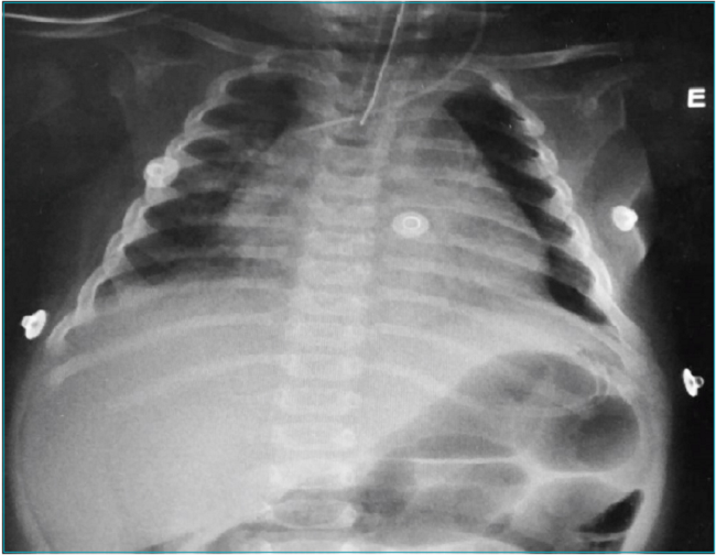 Raio-x do t&oacute;rax.