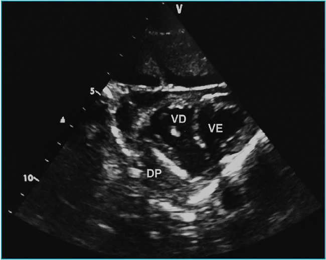 Ultrassonografia card&iacute;aca a partir de eixo curto paraesternal. Derrame peric&aacute;rdico com ecogenicidade heterog&ecirc;nea e septa&ccedil;&otilde;es. VE: ventr&iacute;culo esquerdo; VD: ventr&iacute;culo direito; DP: derrame peric&aacute;rdico.