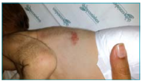 First lesion to appear, located on the left flank.