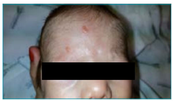 Lesions in the frontal region.