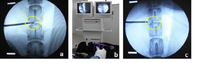 Resección percutánea del disco (discectomía). a) Discectomía percutánea con pinzas grasping. b) Modulación térmica con sistema de radiofrecuencia (Sistema Disc Fx, Elliquence LLC. NY). c) Vista radiográfica de la fibra de Radiofrecuencia en un disco intervertebral canino (Alonso et al. 2013).