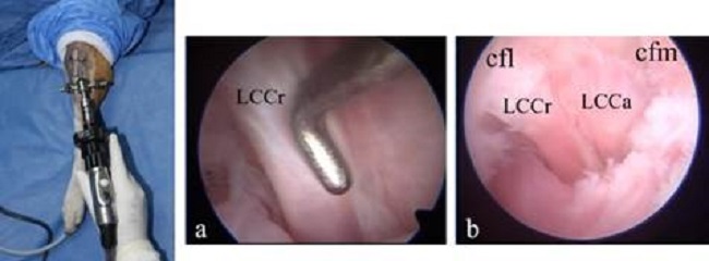 Artroscopia de Rodilla en Perro. a) LCCr: Ligamento Cruzado Craneal; b) LCCa: Ligamento Cruzado Caudal; cfl: Condilo Femoral Lateral; cfm: Condilo Femoral Medial (Alonso y Camacho 2013).