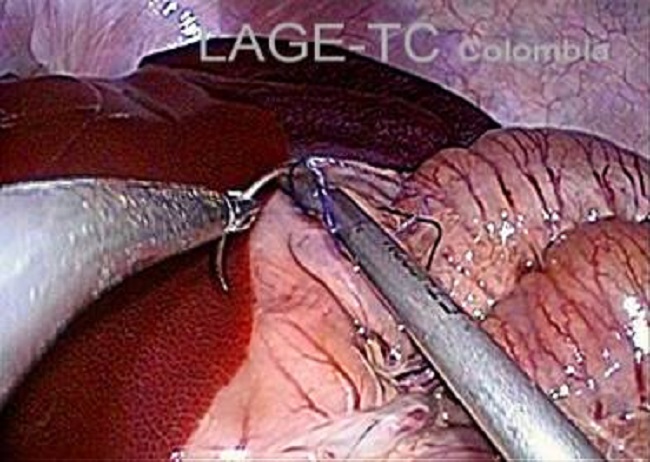 Sutura intracorpórea a través de S.I.L.S. en Cerdo. Nótese la curvatura del portaagujas que permite conseguir el ángulo de ataque y lograr el punto de sutura. (Fotografía usada con permiso del Latin American Gastrointestinal Endoscopy Training Center LAGE-TC. Dr. Eduardo Valdivieso).