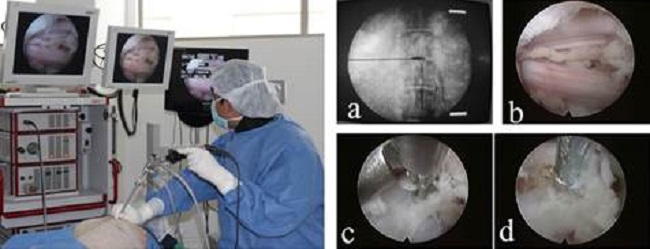 Endoscopia de columna por abordaje interlaminar en cadáver de cerdo como modelo de entrenamiento en cirugía humana. a) Discografía y tinción discal; b) Axila del Nervio Espinal L7-S1; c) Discectomía con pinzas grasping. d) Modulación térmica del tejido discal (Alonso y Rugeles 2017).