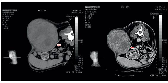 Tomograf&iacute;a computarizada realizada a la paciente; se puede observar la masa empujando las v&iacute;sceras abdominales, sostenida a su vez por el peritoneo (flechas). Izquierda: sin contraste; derecha: con contraste.
