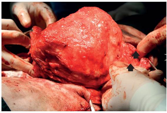 Aspecto intraoperatorio de la masa ya separada de la pared abdominal. Evaluaci&oacute;n de las costillas infiltradas (flechas negras), que fueron la decimosegunda y decimotercera de la pared tor&aacute;cica izquierda.