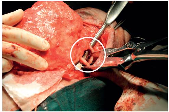 Corte de la decimosegunda y decimotercera costillas cerca de la columna vertebral mediante una pinza para cortar hueso de Liston (circulo).