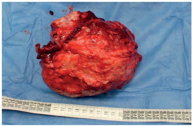 Aspecto y dimensiones de la masa retirada.