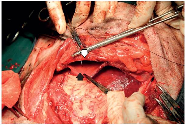 Sutura del diafragma (flecha negra) al remanente de los m&uacute;sculos intercostales en el aspecto caudo-medial de la decimoprimera costilla (flecha blanca).