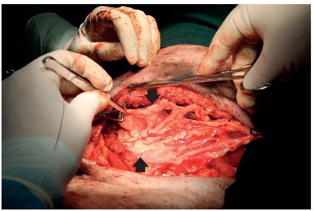 Omento mayor cubriendo el defecto de la pared (fechas) al ser suturado a los bordes del defecto mediante puntos simples interrumpidos (polidioxanona 2-0 PDS&reg; Ethicon).
