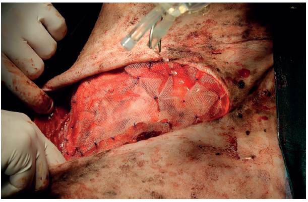 Malla de polipropileno cubriendo el defecto de la pared y el omento previamente suturado. La malla fue suturada a los bordes del m&uacute;sculo oblicuo abdominal externo usando puntos simples interrumpidos (polidioxanona 2-0 PDS&reg; Ethicon).