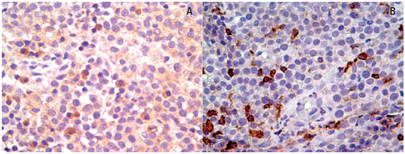 An&aacute;lise imunoistoqu&iacute;mica mostrando baixa express&atilde;o de mol&eacute;culas do MHC classe I e II na fase de progress&atilde;o do TVTC. (A) MHC classe I. (B) MHC classe II. Contracolora&ccedil;&atilde;o Hematoxilina de Meyer, 400x.