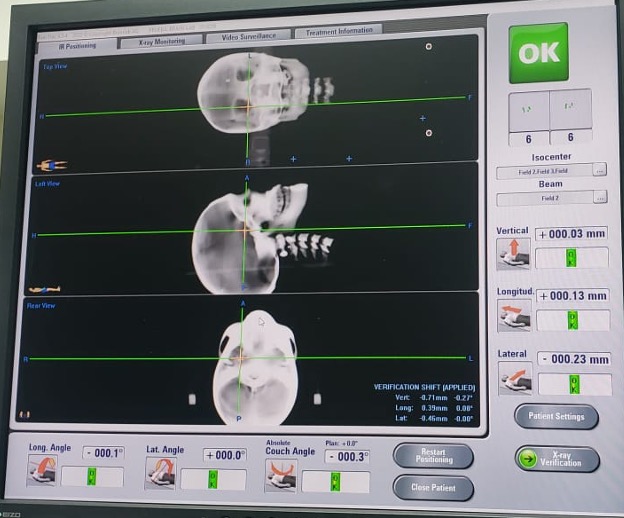 Im�genes DRR del maniqu� de cr�neo indicando el posicionamiento y las correcciones finales.