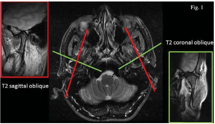 Ilustraci&oacute;n de cortes en RNM de ambas ATM en T2: sagital oblicua y coronal oblicua28.