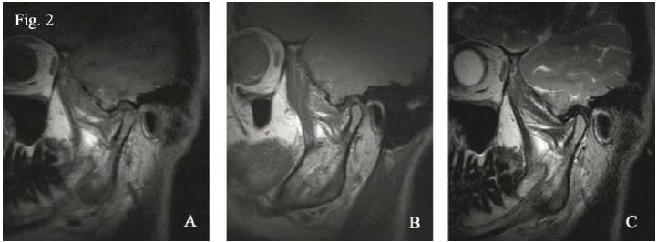 A: Ejemplos de vista parasagital de ATM en boca cerrada. A: imagen ponderada en T1.B: imagen ponderada en difusi&oacute;n prot&oacute;nica. C: imagen ponderada en T2. Se evidencia con mayor facilidad los distintos componentes anat&oacute;micos tanto en la imagen A como B si se compara con la C31.