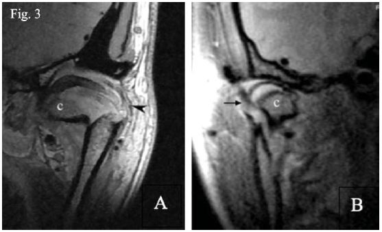 Ambas son im&aacute;genes ponderadas con atenuaci&oacute;n prot&oacute;nica en vista coronal. En la imagen A se menciona que en (c) se ve un fragmento de fractura condilar y una imagen bien deﬁnida de la c&aacute;psula articular (cabeza de ﬂecha). La imagen B graﬁca la imagen bien deﬁnida de la c&aacute;psula articular (ﬂecha negra) y en (c) la fractura del c&oacute;ndilo en la zona medial de la rama mandibular17.