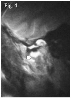 Se se&ntilde;ala en esta imagen sagital ponderada en T2 la disrupci&oacute;n (ﬂecha blanca) de la l&iacute;nea oblicua que representa a la c&aacute;psula. Se especula que corresponde a un desgarro de ella. Adem&aacute;s, que se puede observar efusi&oacute;n y hamartrosis en ambos compartimientos articulares34.