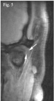 Reformaci&oacute;n coronaria de RNM, donde se visualiza el desplazamiento lateral del disco articular (ﬂechas blancas)42.