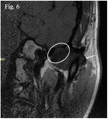 Imagen de archivo del Servicio de Radiolog&iacute;a Bucal y M&aacute;xilofacial de UPCH. Reformaci&oacute;n coronaria en RNM. Se se&ntilde;ala la imagen del disco articular (&oacute;valo) y la c&aacute;psula articular (ﬂecha blanca), distinguibles una estructura anat&oacute;mica de la otra.
