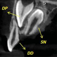 Figura 1.Ejemplo representativo de una tomograf&iacute;a computada de haz c&oacute;nico (TCHC) que muestra en un corte sagital un diente supernumerario SN en el maxilar superior en posici&oacute;n invertida que dificulta la correcta erupci&oacute;n del diente permanente DP, el diente deciduo DD no se encuentra afectado. Imagen tomada del archivo del Servicio de Radiolog&iacute;a Bucal y Maxilofacial &ndash; Universidad Peruana Cayetano Heredia.