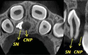 Figura 2. Ejemplo representativo de una tomograf&iacute;a computada de haz c&oacute;nico (TCHC) en corte axial y coronal que muestra un diente supernumerario SN en el maxilar superior en posici&oacute;n invertida adyacente al conducto naso palatino CNP. Imagen tomada del archivo del Servicio de Radiolog&iacute;a Bucal y Maxilofacial &ndash; Universidad Peruana Cayetano Heredia.