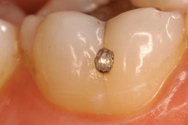 Figure 2. Initial buccal view.