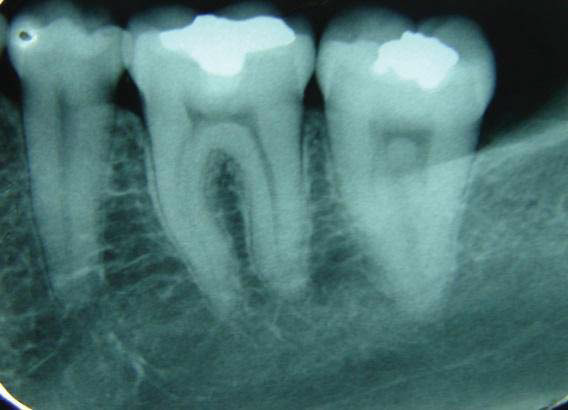 Figure 3. Baseline radiograph.