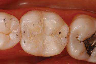 Figure 4. Final restoration after occlusal adjustment.