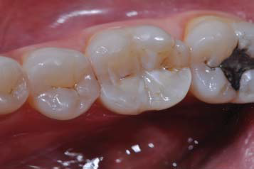 Figure 5. Restored tooth of a 7-year monitoring period.
