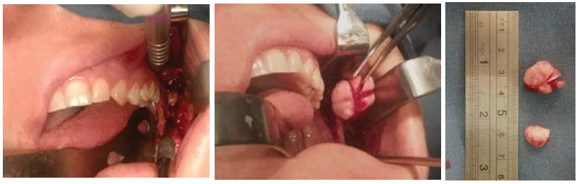 Figure 3. Injury intraoral access removal.