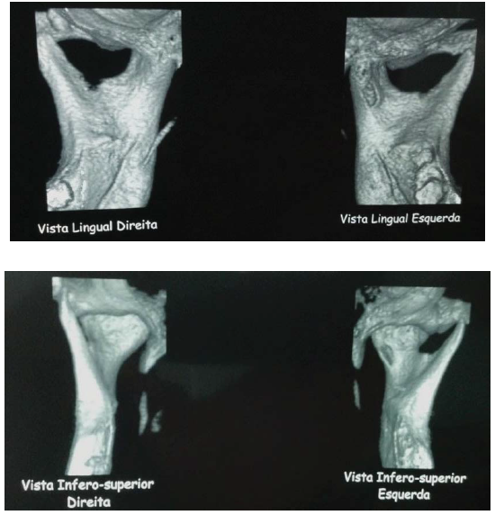 Figure 4. Cone beam computed tomography images, after 6 months of the condylar lesion surgical removal, for postoperative follow-up.